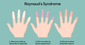 Tips for Dealing with Red Fingertips tips of fingers red